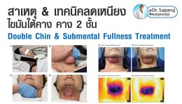 สาเหตุ & เทคนิคลดเหนียง ไขมันใต้คาง คาง 2 ชั้น Double Chin & Submental Fullness Treatment 